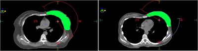 Application of tangent-arc technology for deep inspiration breath-hold radiotherapy in left-sided breast cancer